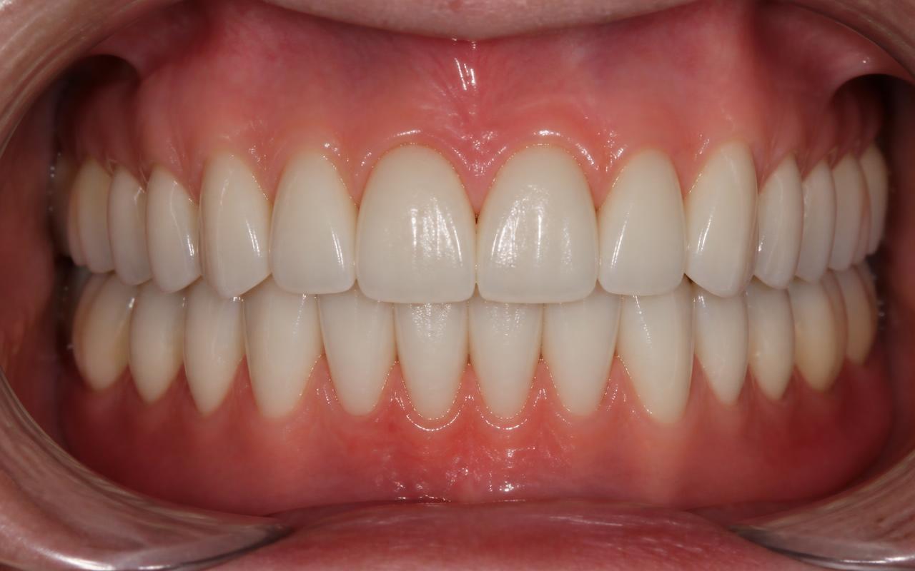Full Mouth Implants after