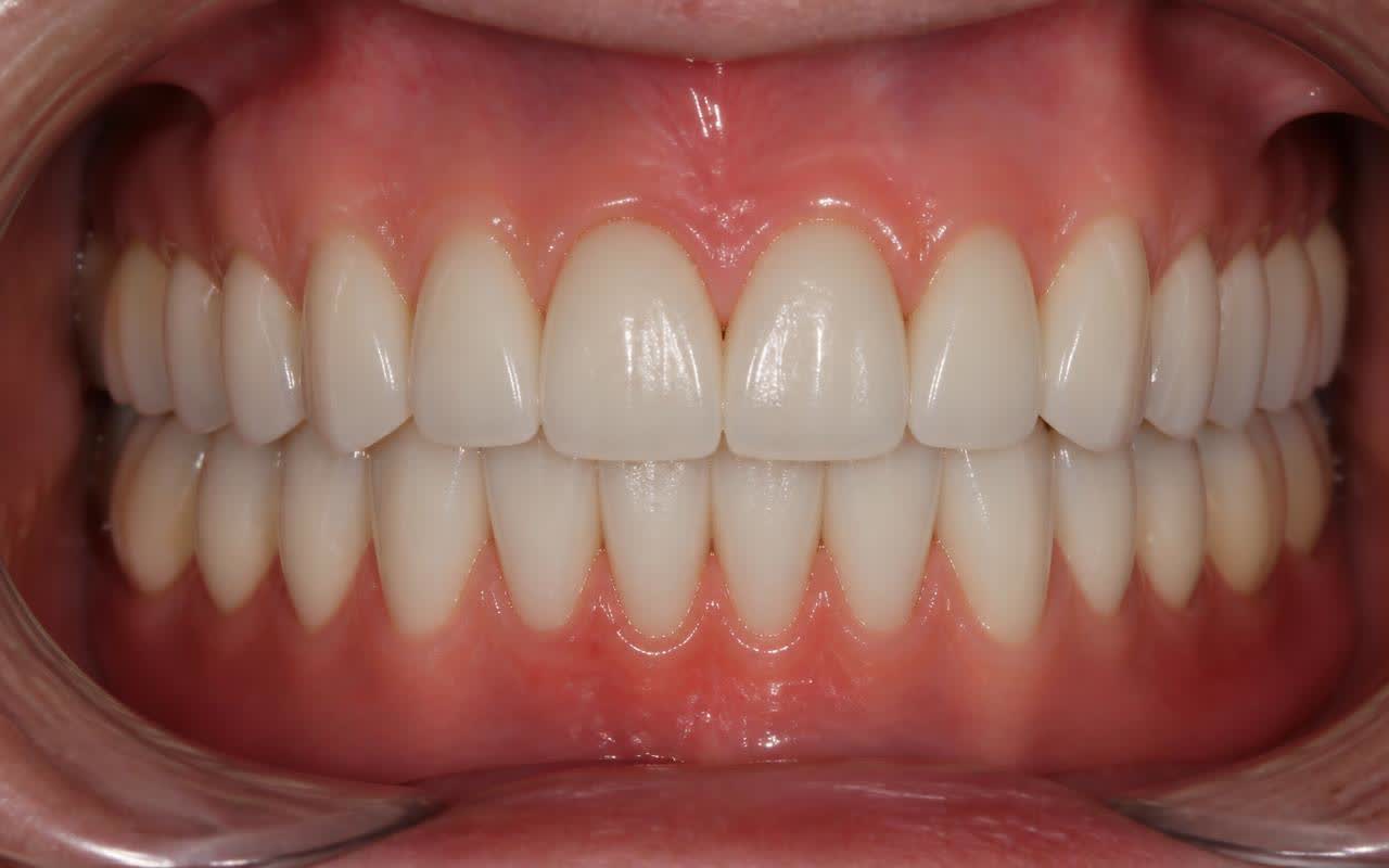 Full Mouth Implants after