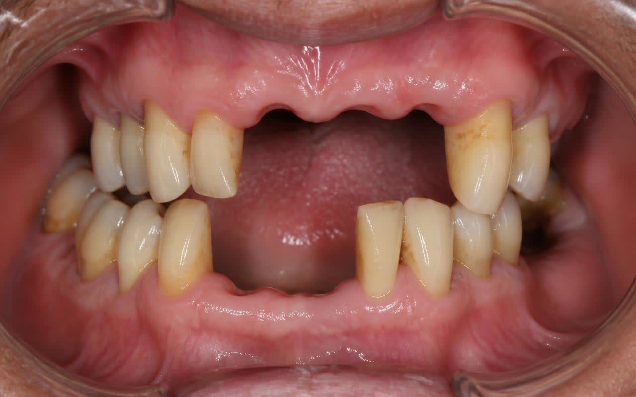 Full Mouth Implants before