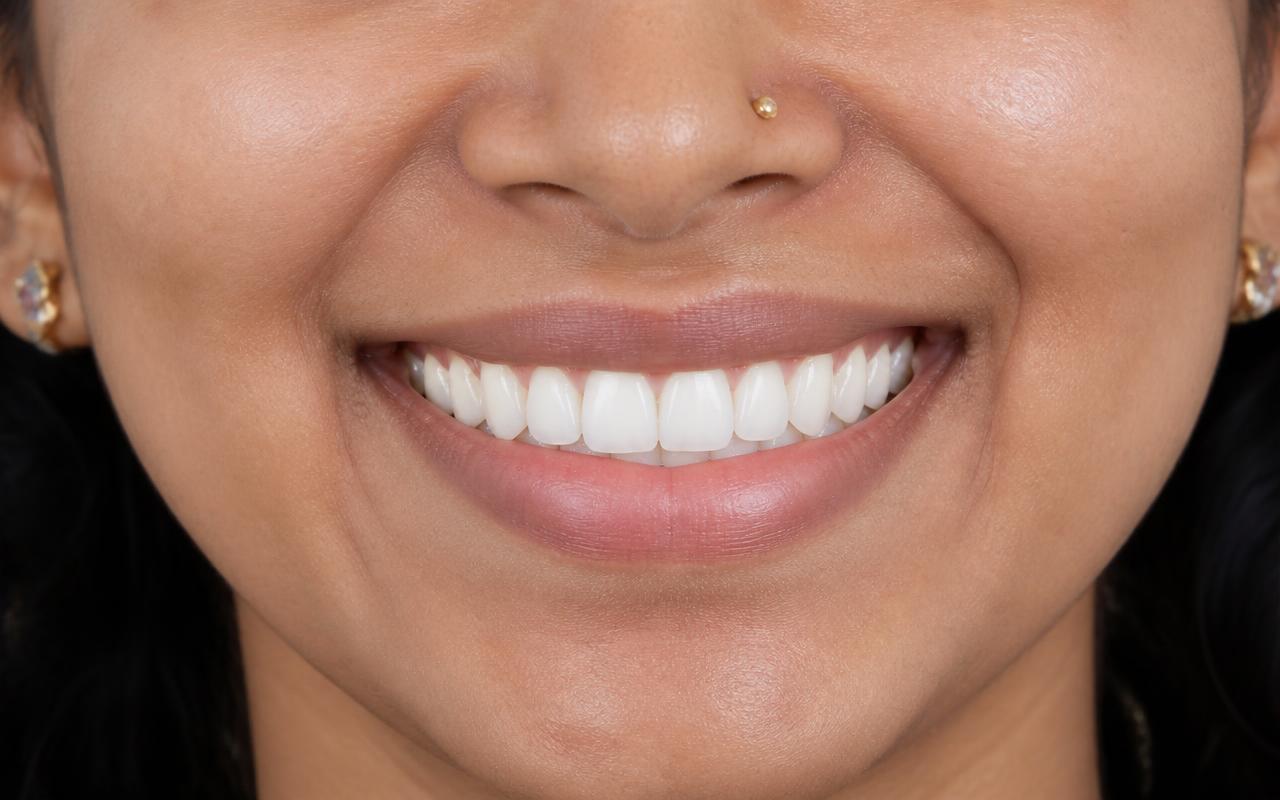 Smile Makeover after