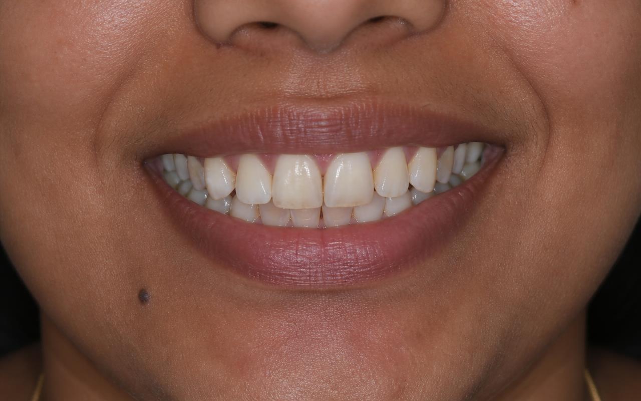 Smile Makeover before
