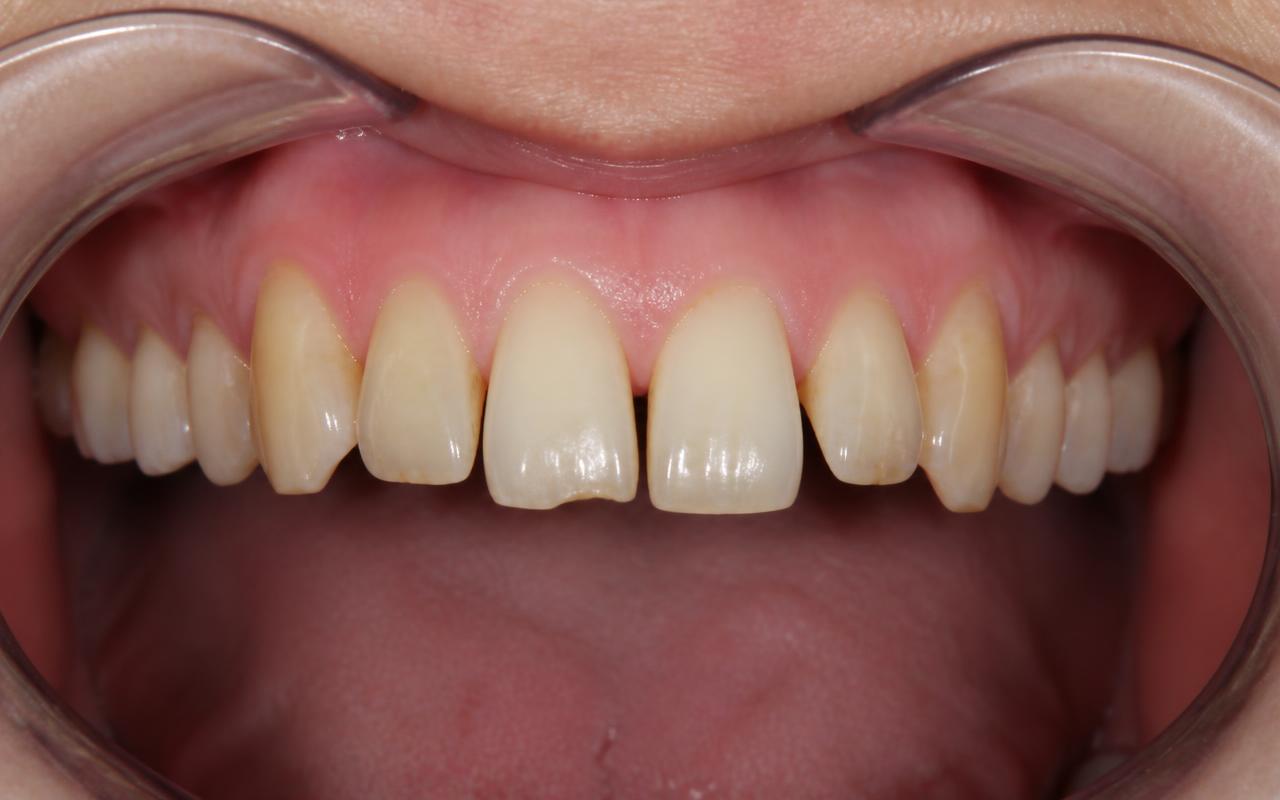 Cosmetic Veneers before