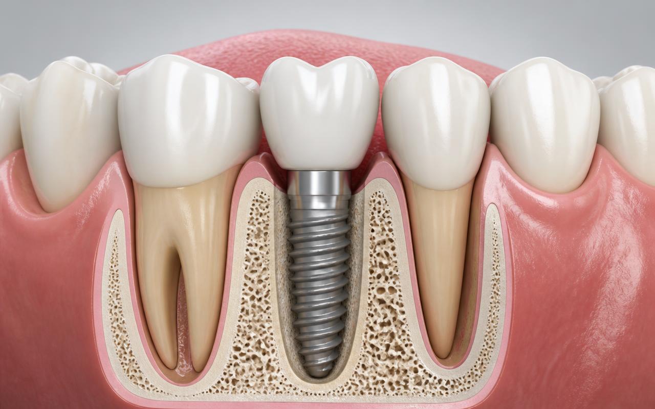 Dental Implants